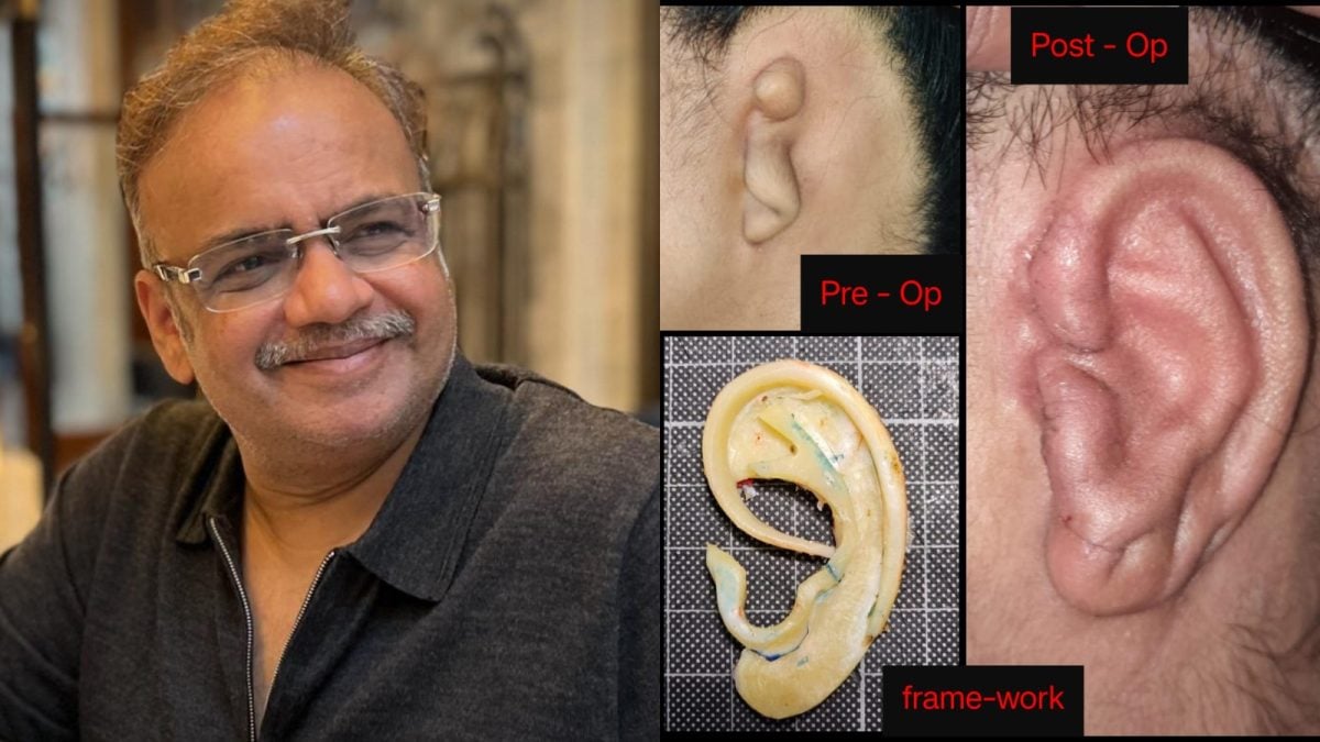 Microtia Awareness Day: Understanding the Congenital Ear Condition