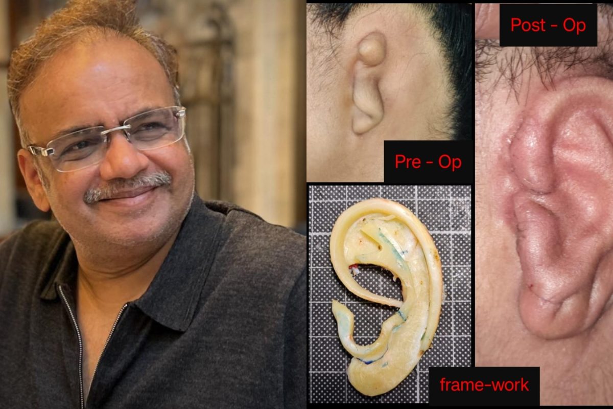 Microtia Awareness Day 2025: History, Challenges, And Treatment Options