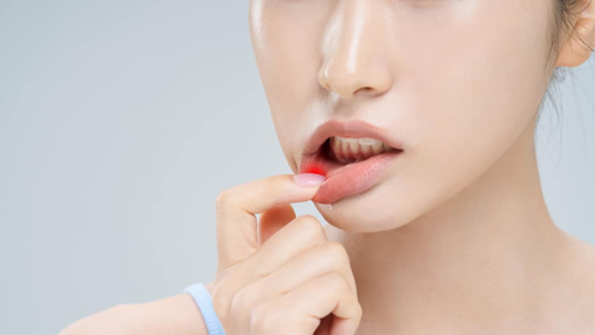 Suffering From Mouth Ulcers? Try These Easy And Effective Home Remedies