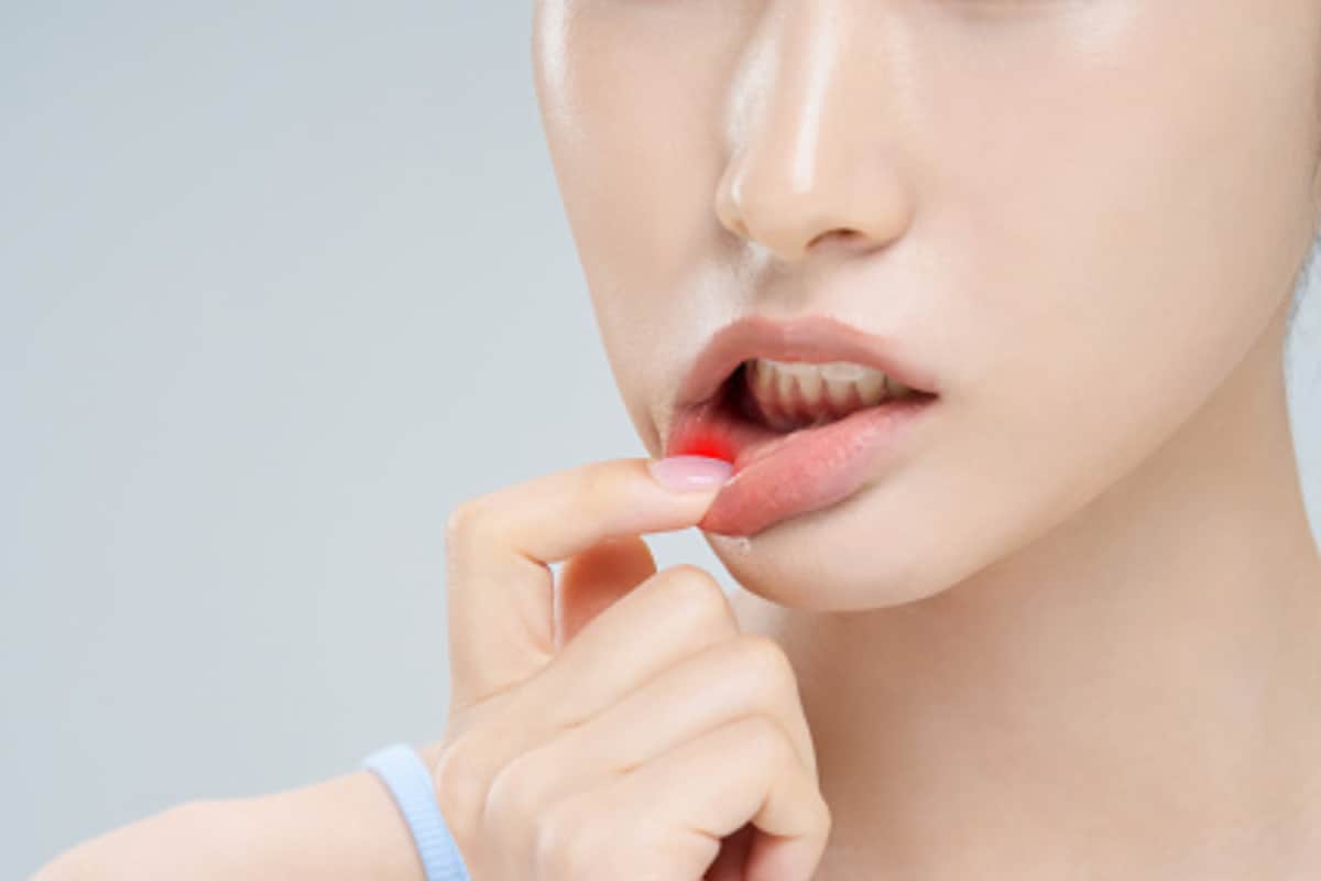 Suffering From Mouth Ulcers? Try These Easy And Effective Home Remedies