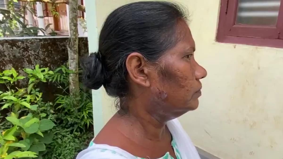 Kerala Poll Officer Attacked By Pet Dog During Voter List Revision Visit