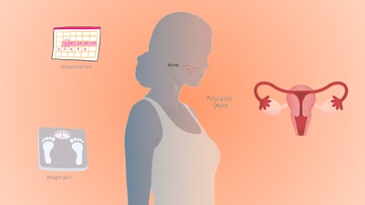 Hormonal changes throughout life can make it more difficult for women to control their weight, aggravating conditions such as metabolic syndrome, menopausal changes, and polycystic ovarian syndrome (PCOS)