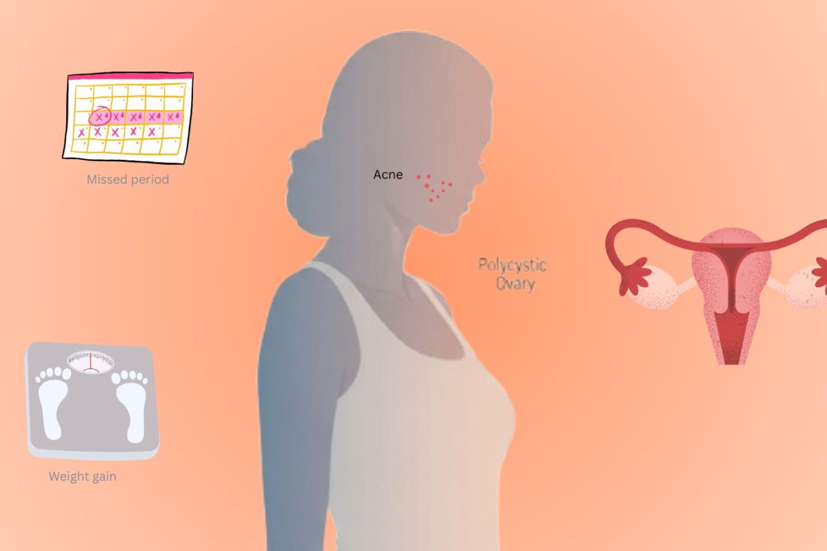 She Studied PCOD In Medical School But Didn’t Recognise It Until She Missed Periods And Gained Weight
