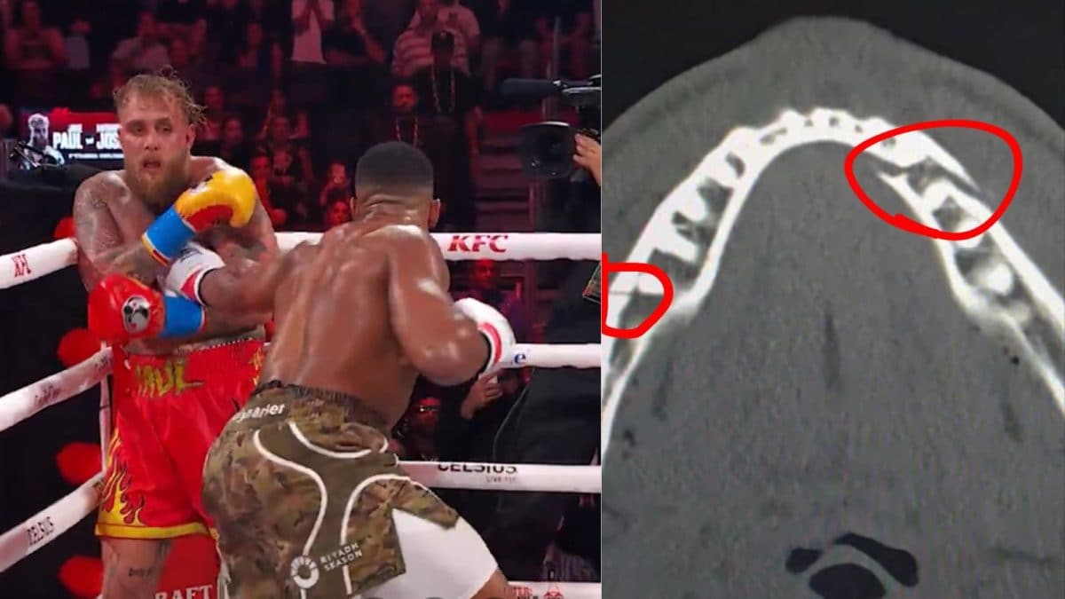 'Give Me Canelo In...', Jests Jake Paul After Suffering Double Broken Jaw Against Anthony Joshua