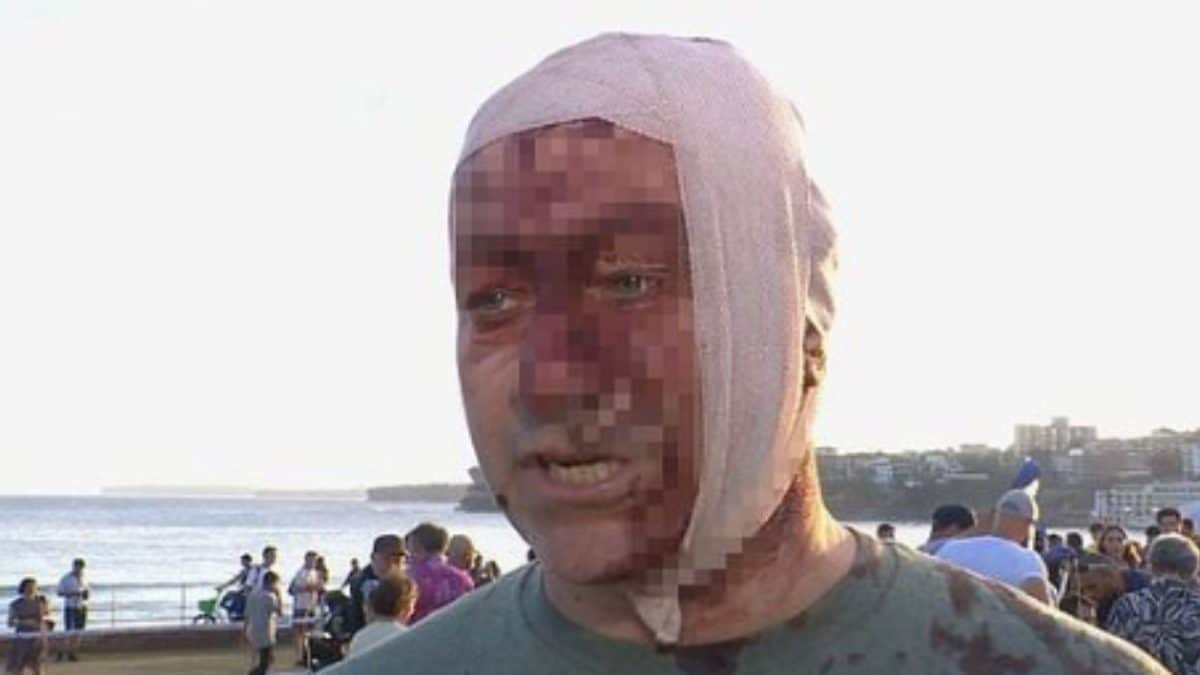 'Never Thought To Witness This In Australia': October 7 Attack Survivor Injured In Sydney Shooting