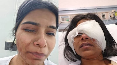 Woman Suffers Serious Eye Injury After Bike-Borne Men Chase Car. (CNN News18)