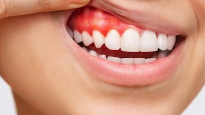 Bleeding gums are often an early warning sign of gum disease and should never be ignored, as timely care can prevent serious oral health complications.