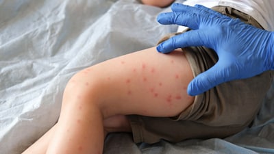 In India, measles elimination would not only prevent deaths but reduce the burden on an already stretched healthcare system and improve childhood health outcomes (Image: Getty)