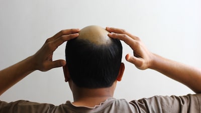 Gen Z is facing hair loss earlier than ever. Stress, screen time, diet, and lifestyle changes are causing thinning hair, receding hairlines, and anxiety. (Image-Getty Images)