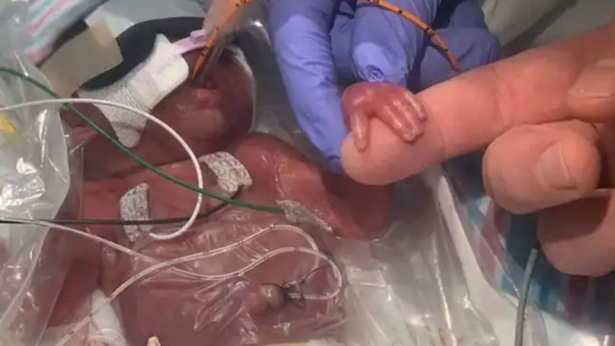 Baby Born at 22 Weeks Beats 5% Survival Odds