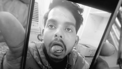 Victim Vipin shows his tongue that his wife bit off after a dispute. (News18)