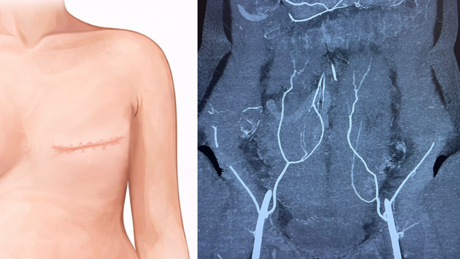 'I Wanted To Feel Like Myself Again As A Woman': How Breast Reconstruction Became A Turning Point After Cancer At 48 'I Wanted To Feel Like Myself Again As A Woman': How Breast Reconstruction Became A Turning Point After Cancer At 48