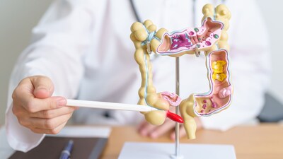 The increasing incidence of colorectal cancer among younger adults reflects the biological consequences of rapid lifestyle modernisation