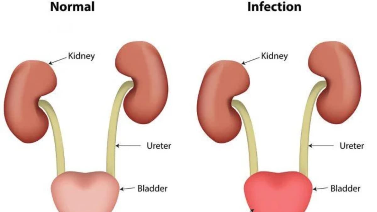 Ignoring Urinary Problems? Expert Warns Of Serious Health Risks And Early Warning Signs | Health and Fitness News