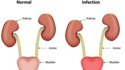 Urinary Problems: Early Symptoms, Health Risks and When to See a Doctor