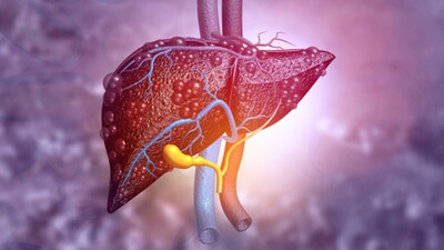 लिवर सिरोसिस के 8 शुरुआती संकेत: त्वचा से थकान तक, शरीर दे रहा है चेतावनी.