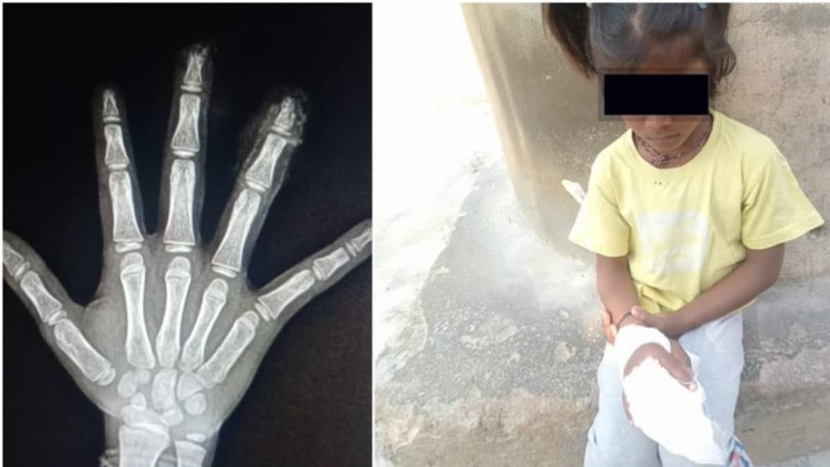 Karnataka Girl's Fingers Severed In School, Parents Say Staff Discarded Them