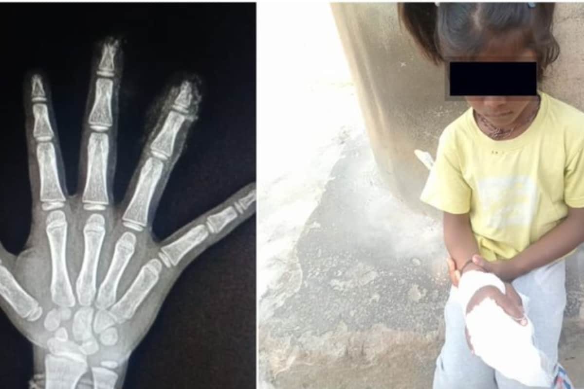 Karnataka Girl’s Fingers Severed In School, Parents Say Staff Discarded Them