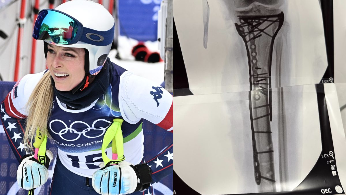 Amputation Avoided? US Olympic Skiier Lindsey Vonn Reveals Chilling Details About Surgery