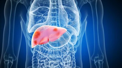 Alcohol and lifestyle are independent risk factors that can also act together to worsen liver health