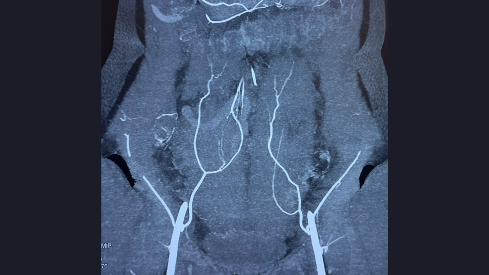 'I Wanted To Feel Like Myself Again As A Woman': How Breast Reconstruction Became A Turning Point After Cancer At 48 'I Wanted To Feel Like Myself Again As A Woman': How Breast Reconstruction Became A Turning Point After Cancer At 48