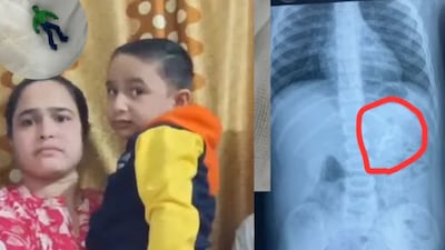 After a great deal of patience and precision, the doctors managed to firmly grip the end of the toy and carefully pull it past the valve without causing injury. (Local18)