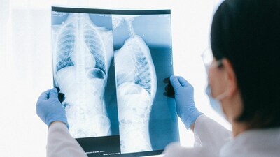 One symptom of lung cancer can be coughing blood, even in small quantities, and it is a dangerous sign.