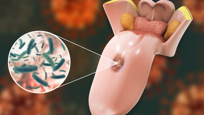 Mouth cancer is the uncontrolled growth of abnormal cells in the mouth, also referred to as the oral cavity. It can develop on the lips, inner cheeks, gums, tongue, roof or floor of the mouth. Here is a compilation of 7 silent symptoms and signs that should not be ignored. (Image-iStock)