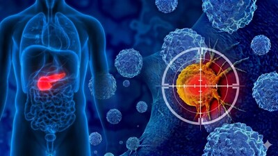 What is Pancreatic Cancer? This cancer begins when abnormal cells grow in the pancreas, an organ behind the stomach that produces digestive enzymes and blood sugar-regulating hormones. It often develops silently and becomes dangerous. (Image-AI)