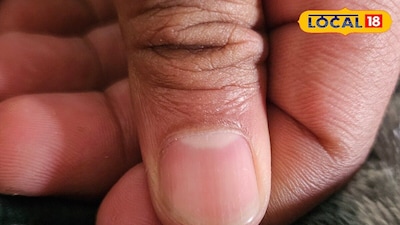 White Nail Spots: Not Calcium Deficiency! Discover the Real Causes