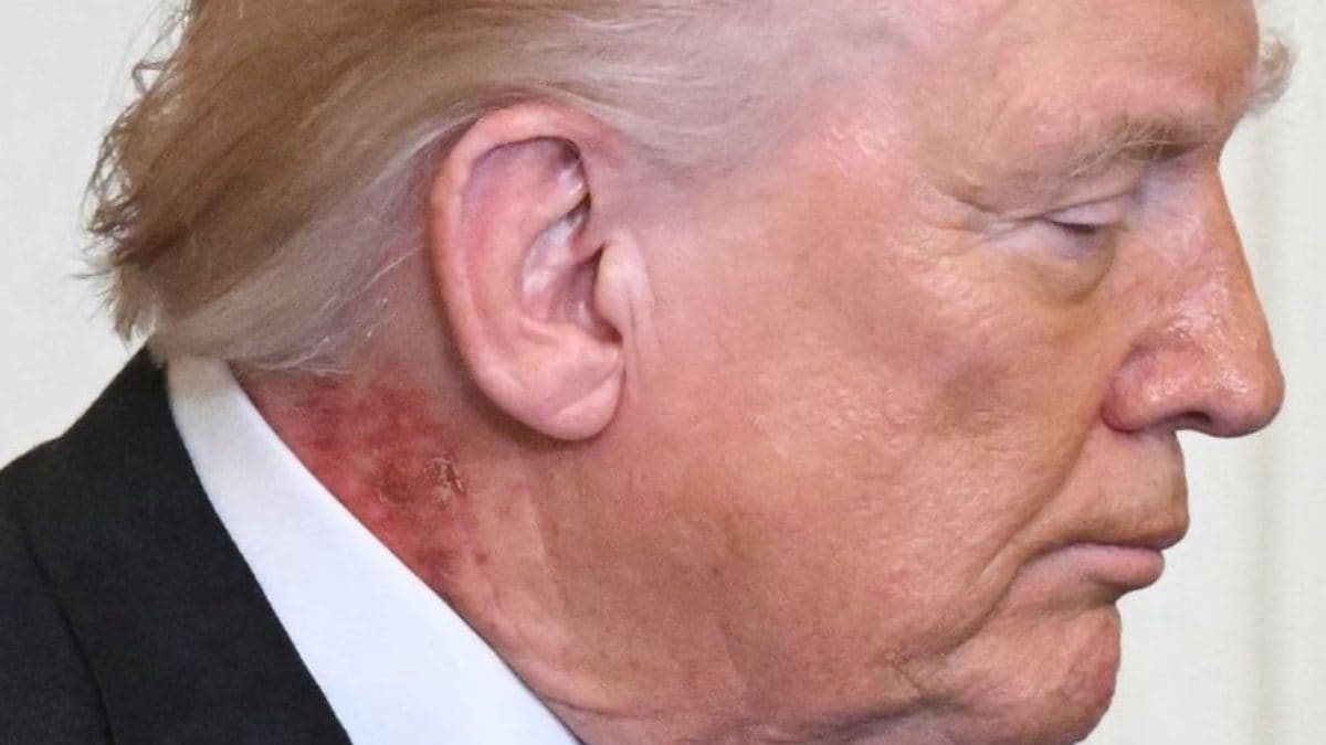 Red Rash Appears On Trump's Neck, Doctors Say Caused By Skin Cream