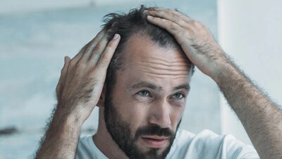 The rise of early hair loss among Gen Z men signals a broader shift in health patterns, where stress, diet, and lifestyle are beginning to show visible effects much sooner than before.