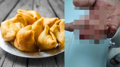 Customer allegedly bit a shopkeeper’s finger following an argument over the bill.