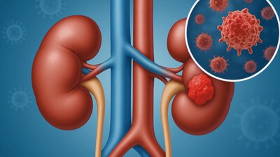 Kidney Cancer: Why Early Detection Is Necessary And Silent Symptoms You Should Not Ignore