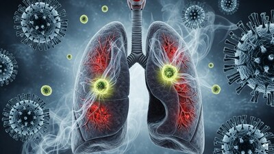 Researchers found that when patients experience serious cases of Covid-19 or influenza, the infection can leave the lungs in a prolonged state of inflammation, which can make it easier for cancer cells to grow.