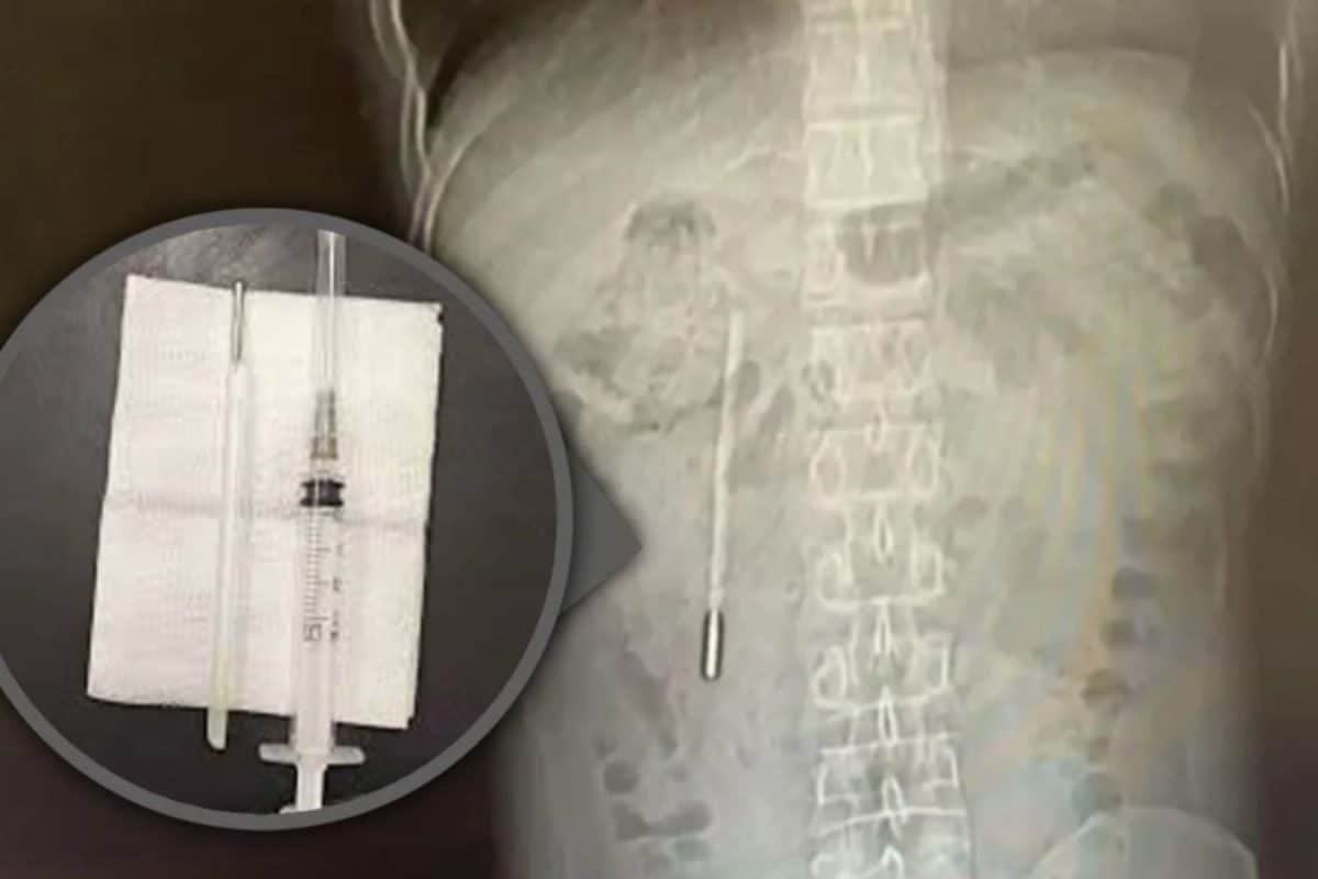 Doctors Find Thermometer Inside Man 20 Years After He Swallowed It As A Child