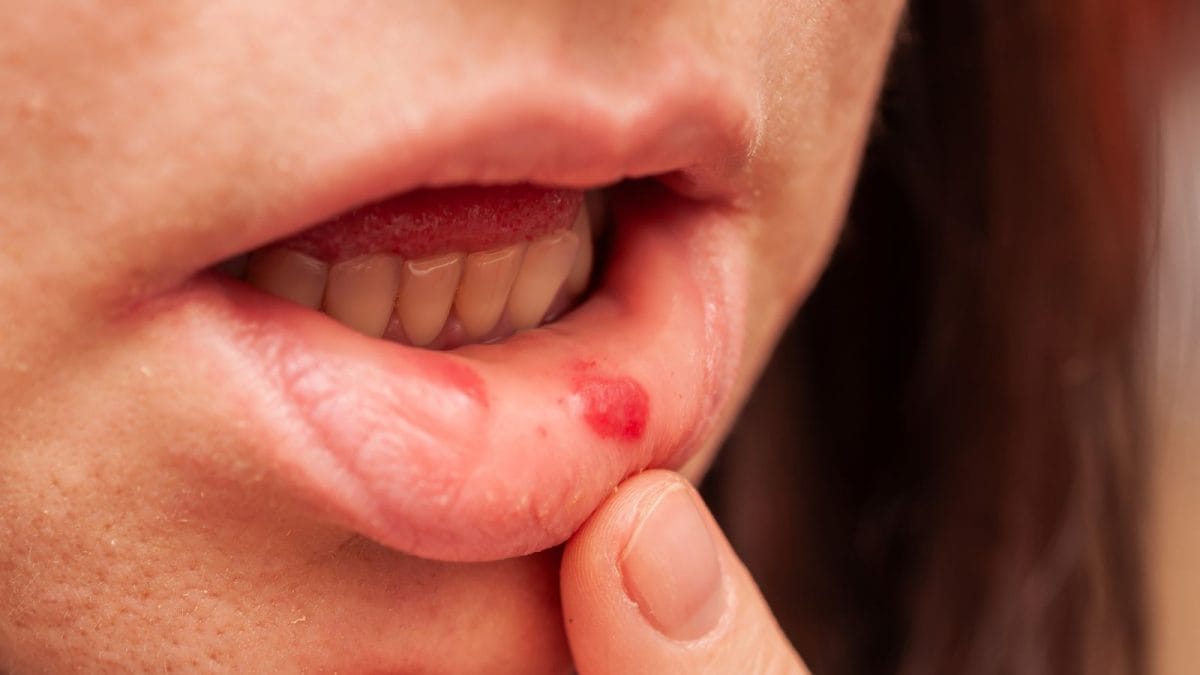 How I Beat Those Annoying Mouth Sores with Simple Kitchen Tricks
