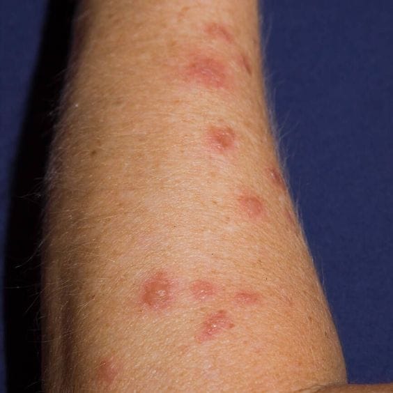 Officials warn that contact with its tentacles can lead to intense burning pain, skin irritation and rashes. In severe cases, breathing difficulty or stronger allergic reactions. Because of these risks, authorities have urged visitors not to touch or pick up any washed-up marine creatures on the beach. Officials warn that contact with its tentacles can lead to intense burning pain, skin irritation and rashes. In severe cases, breathing difficulty or stronger allergic reactions. Because of these risks, authorities have urged visitors not to touch or pick up any washed-up marine creatures on the beach.