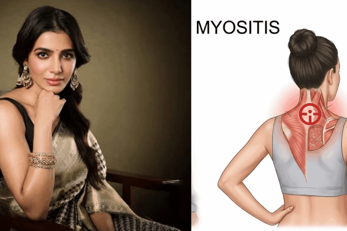 Samantha Ruth Prabhu's Pregnancy After Battling Myositis: Understanding Motherhood With An Autoimmune Condition