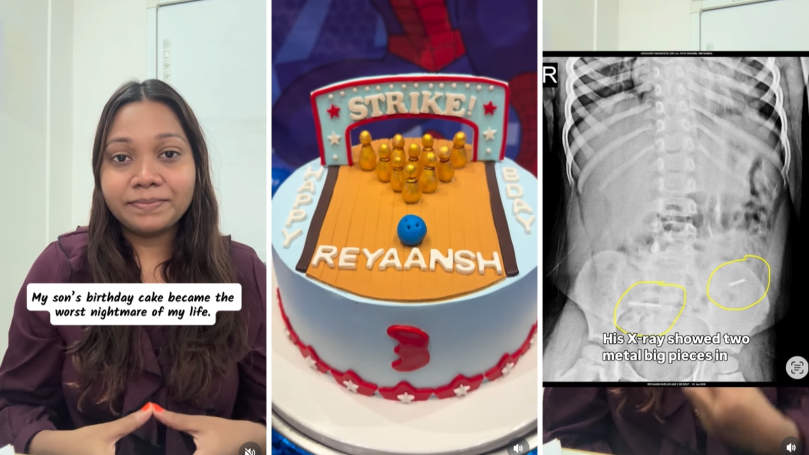 Three-year-old Thane toddler swallows metal pins from birthday cake; mother alleges baker failed to disclose details