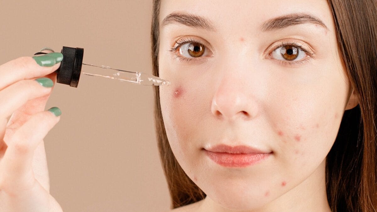 Acne Awareness Month: 5 Home Remedies That Have Proven To Work To Reduce Spots