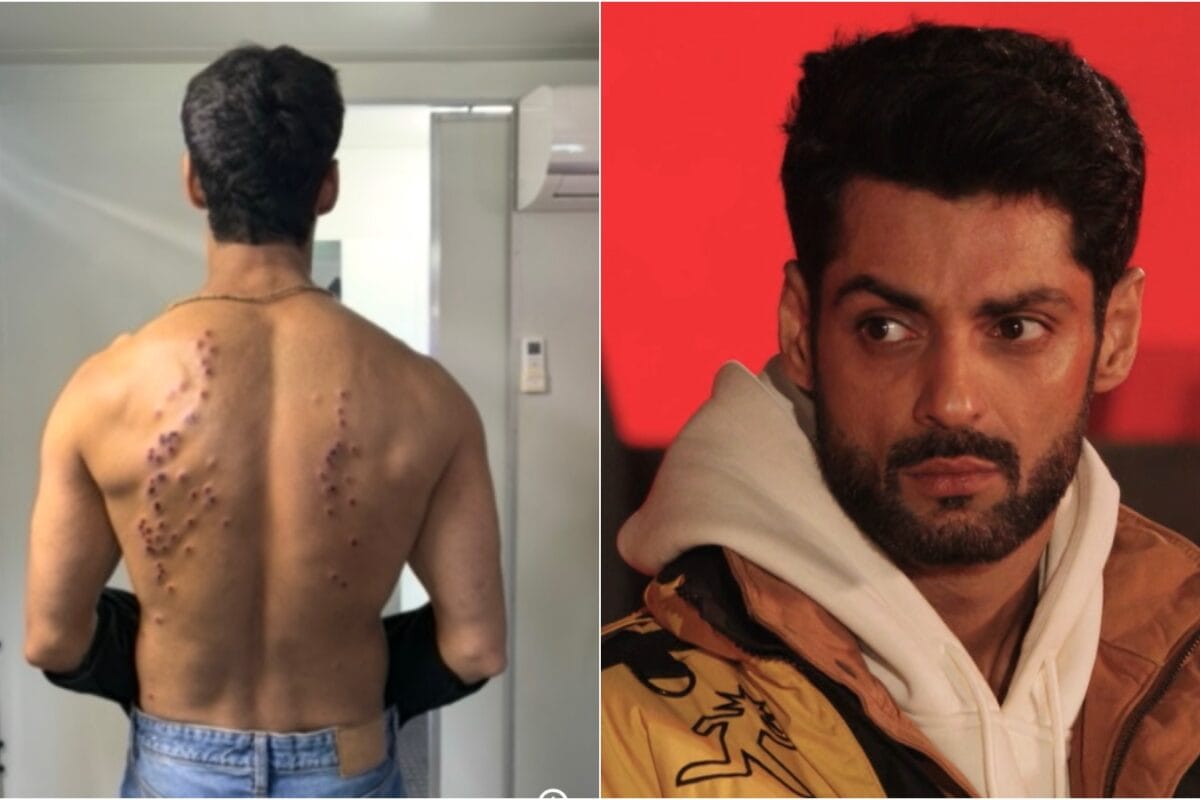 After Gaurav Khanna, Karan Wahi Shares Injury Marks From Khatron Ke Khiladi 15 Task: ‘Scariest Season’