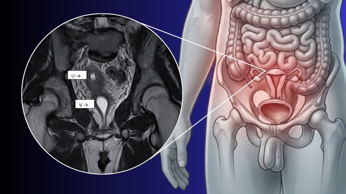 Infertility Test Reveals A Uterus Inside A 26-Year-Old Delhi Man: Know The Rare Condition Behind The Discovery?