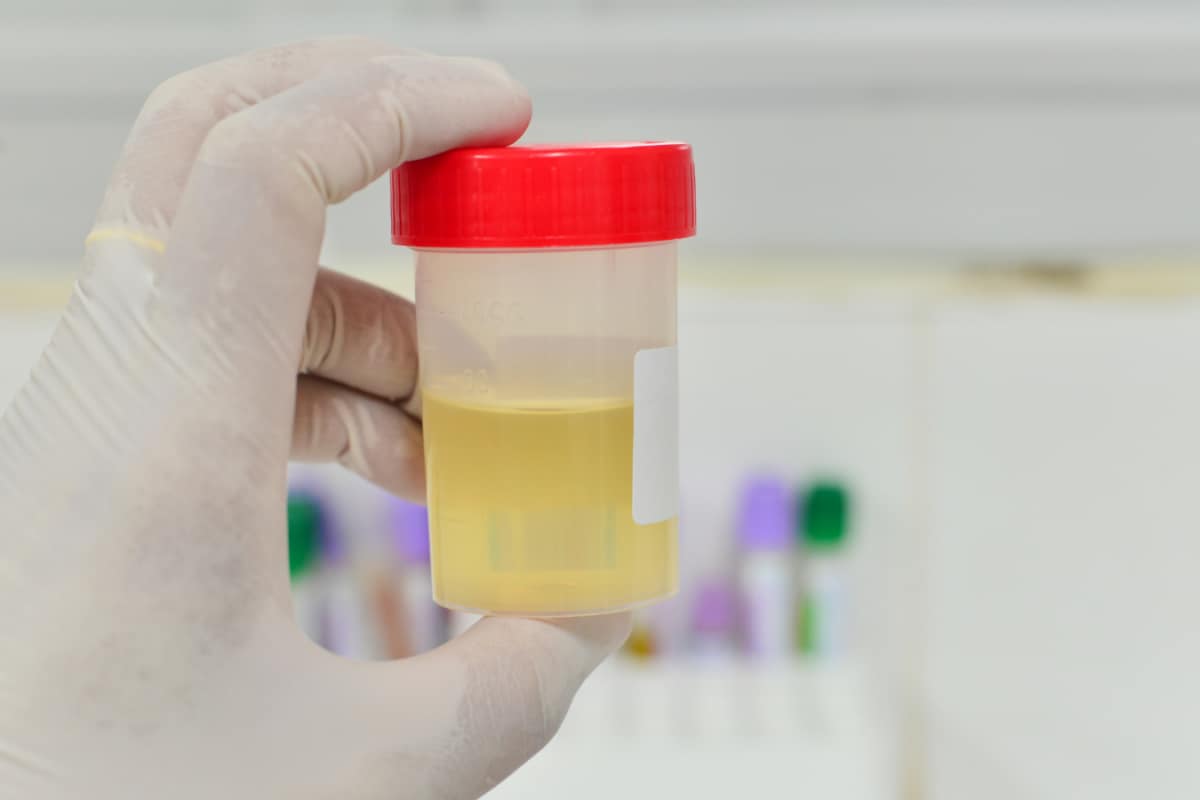 No Painful Procedure? A Simple Urine Test May Help Detect Bladder Cancer