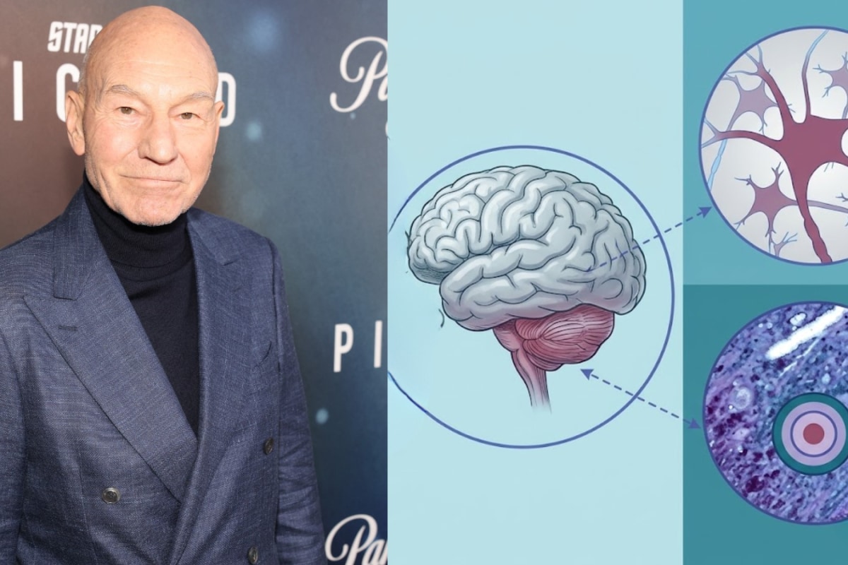 Patrick Stewart Dies At 86 After Battling Alzheimer’s And Lewy Body Dementia: What To Know