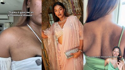 Influencer Sarah Sarosh Diagnosed with Rare Skin Disease Lichen Planus Pigmentosus