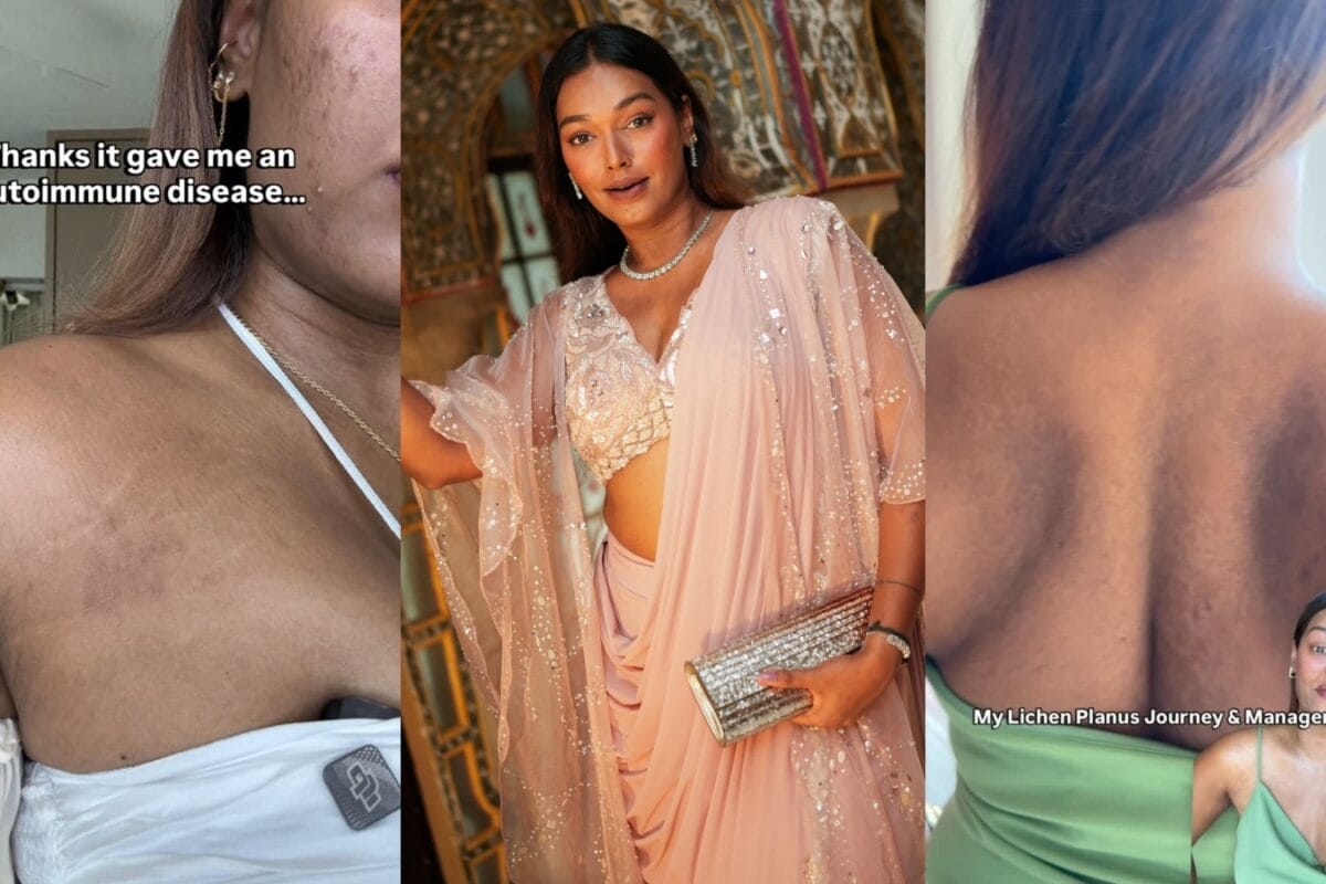 This Influencer Was Diagnosed With Rare Autoimmune Disease: What Is Lichen Planus Pigmentosus?