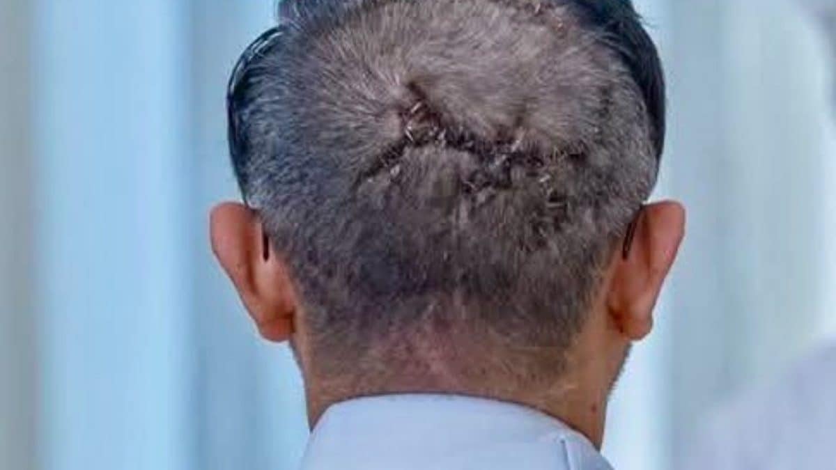 Stitches On Captain Smit Machchhar's Head Seen As Indian Pilot Gets UAE's Top Civilian Honour