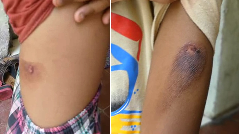 टीव्हीचा आवाज वाढवला म्हणून मामाने दिले भाच्याला चटके