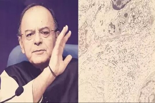 काय आहे Soft tissue sarcoma ज्याच्याशी अरुण जेटलींची झुंज अपयशी ठरली?